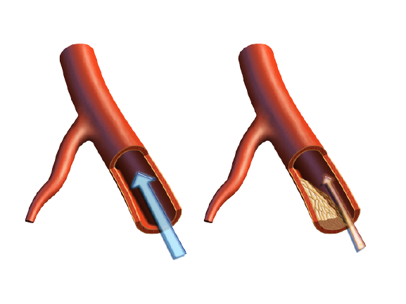 Blood Vessel Calcification