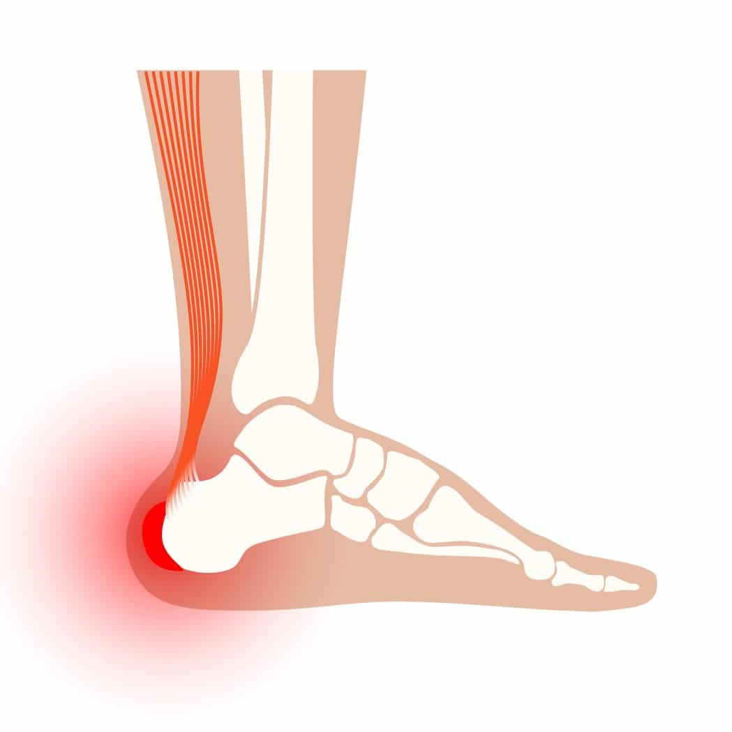 Anterior Achilles Tendon bursitis
