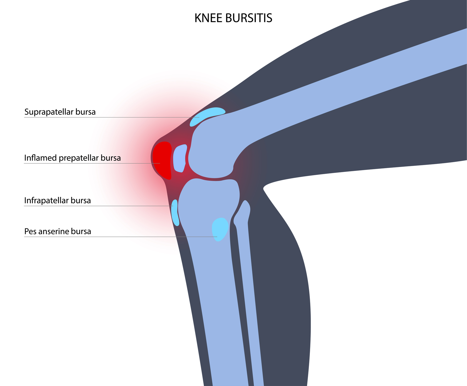 Knee Bursitis