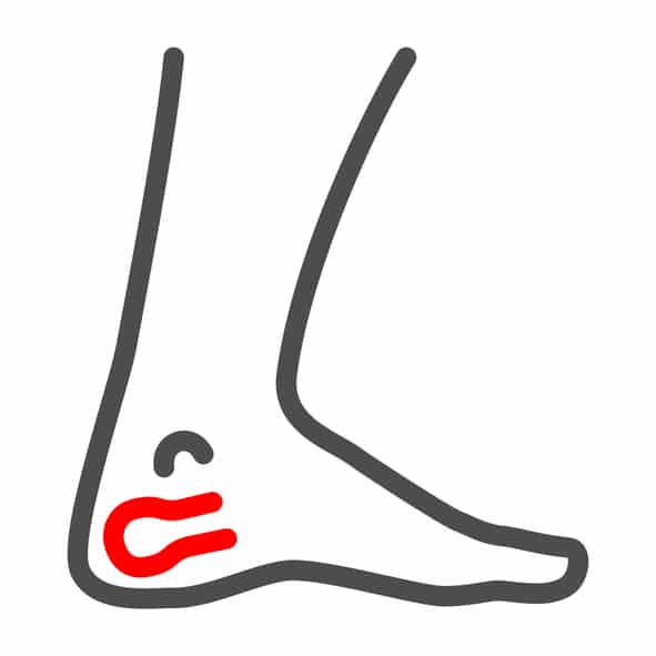 Posterior Achilles Tendon bursitis